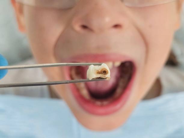 Best Knocked-Out Tooth (Avulsed Tooth) Treatment in Carbon Hill, AL
